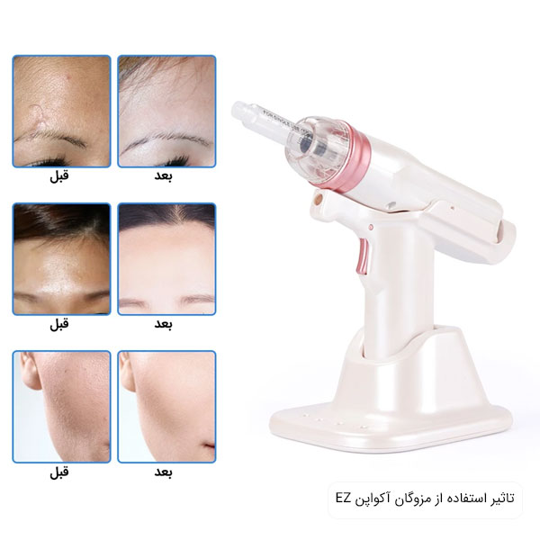 مزوگان اکواپن و تاثیر گذاری آن قبل و پس از استفاده در تصویر مشهود می باشد.