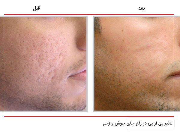 قبل و بعد استفاده از پی ار پی صورت برای رفع جای جوش ، زخم و اسکار در تصویر با زمینه سفید کاملا مشخص می باشد