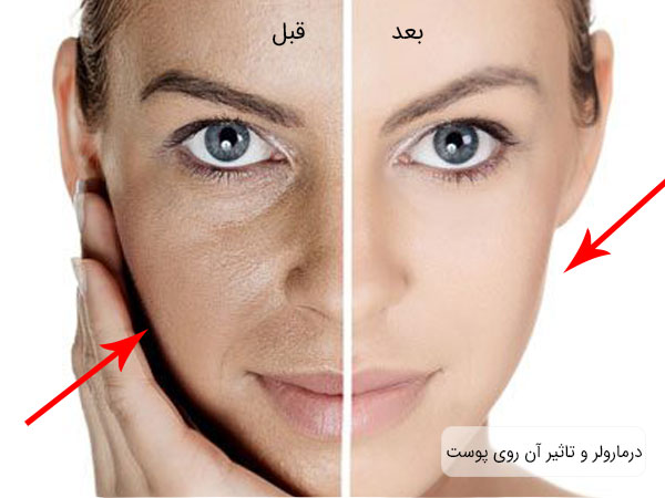 تصویر قبل و بعد از استفاه از یک خانم ا درمارولر و تاثیرات آن بر روی صورت این خانم کاملا مشهود می باشد