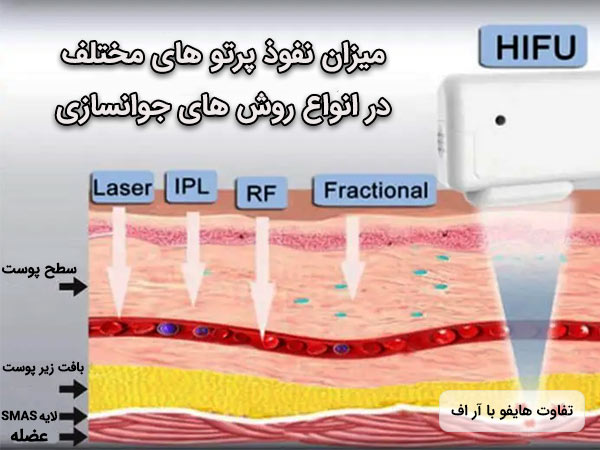 تفاوت هايفو و آر اف در ميزان نفوذ امواج مغناطيسي