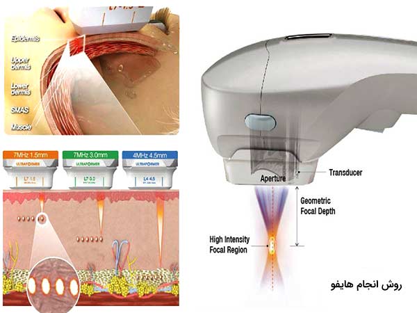 ساز و کار روش هايفو بر روي پوست