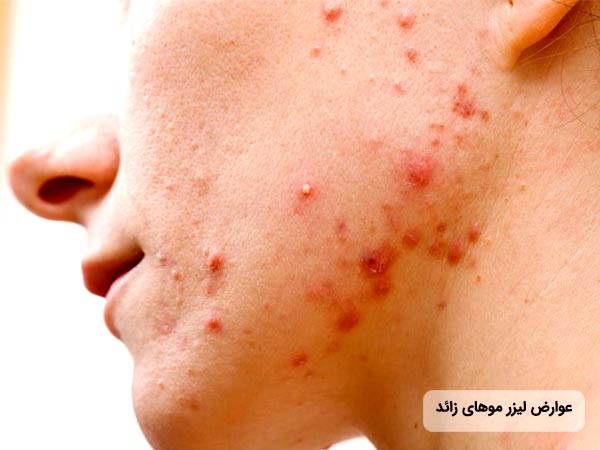 صورت يک آقا جوش و زخم دارد