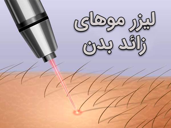 اشعه ليزر در حال اصابت به موهاي پوست مي باشد.