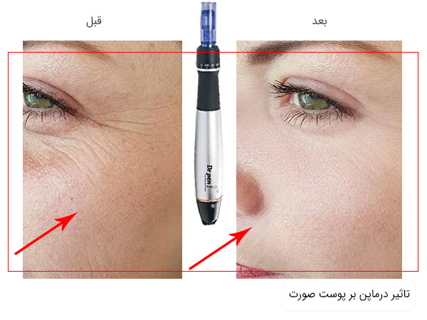 تصویر قبل و بعد از استفاده از درماپن و تاثیر مشهود آن بر روی چروک های صورت . زمینه تصاویر سفید می باشد.