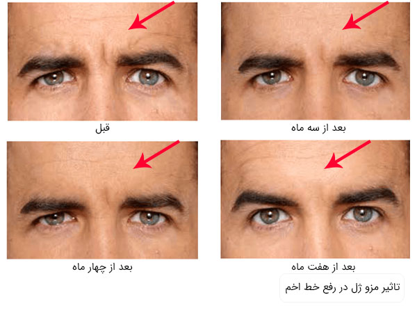 تصویر خط اخم موجود در رپیشانی و تاثیر استفاده از مزو ژل در رفع آن در سه فاصلع زمانی در تصویر با زمینه سفید مشخص می باشد
