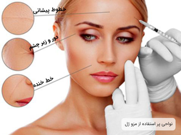 نواحی مورد استفاده از مزو ژل که بیشتر مشمول این روش جوانسازی می شوند در تصویر مشهود می باشد . زمینه تصویر سفید می باشد