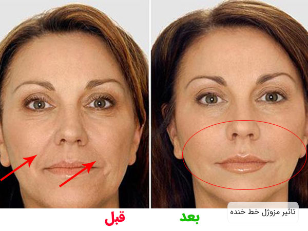 تصویر بعد و قبل استفاده از مزو ژل برای اصلاح خط خنده و زمینه تصویر سفید می باشد . این تصویر با مقاله مزو ژل در ارتباط می باشد