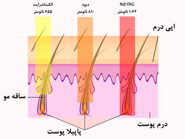 مقايسه طول موج ليزر هاي ديود و الکساندرايت و Nd:YAG