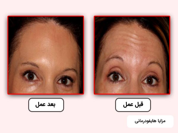 نتايج قبل و بعداز انجام هايفو بر روي پوست پيشاني