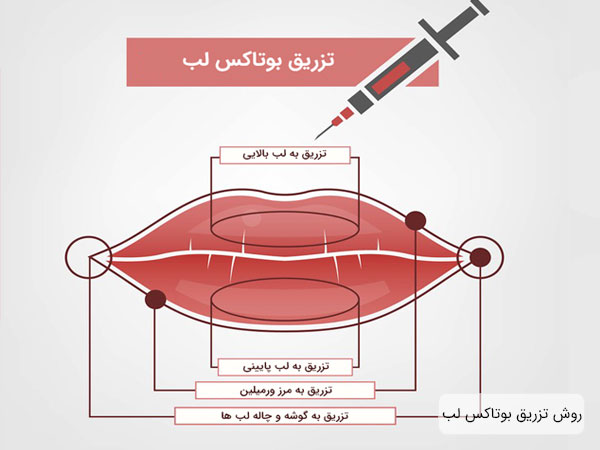 نحوه تزریق بوتاکس لب در تصویر کاملا مشخص میباشد . نقاط مهم برای تزریق بوتاکس لب هم در تصویر مشخص است
