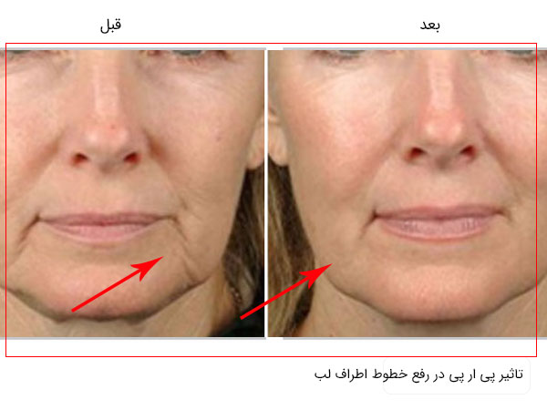 تاثیر پی ار پی در رفع خطوط اطراف لب در تصویری با زمینه سفید مشخص می باشد