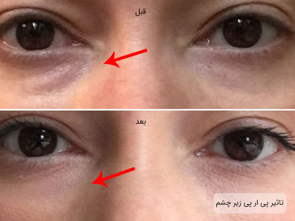 تاثیر استفاده از پی ار پی برای زیر چشم در تصویر مشهود می باشد . زمینه تصویر صورت یک فرد با نمای بسته از چشمانش می باشد