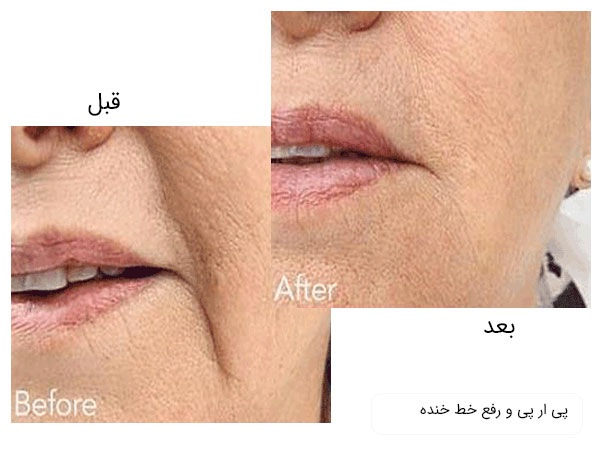 تصویر تاثیر پی ار پی در از بین بردن خط خنده با زمینه صورت یک فرد .