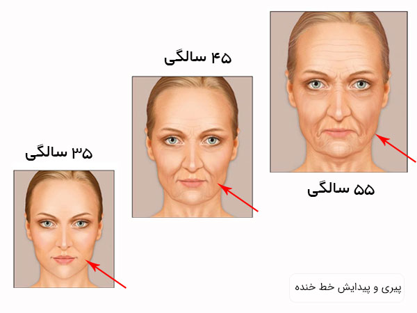 تاثیر پیری و افزایش سن بر پیدایش خط خنده در تصویر کاملا نمایان می باشد
