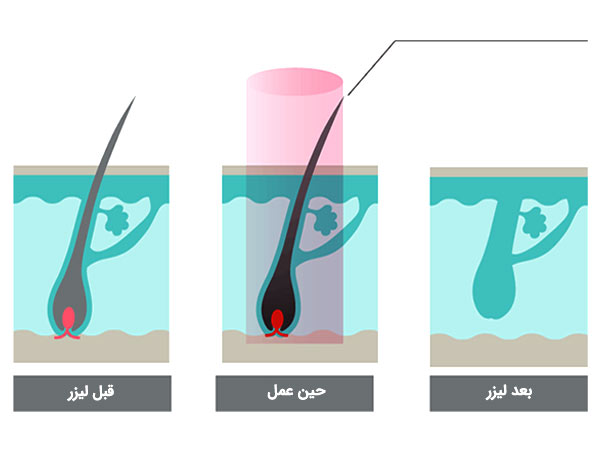 چگونگي رفع موهاي زائد با استفاده از ليزر