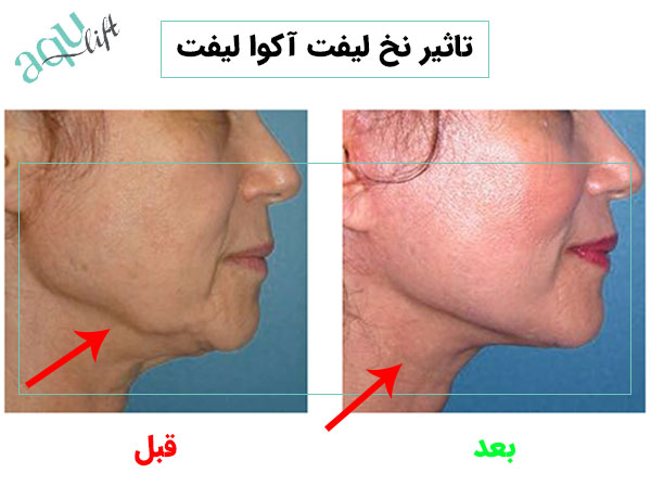 تاثیر استفاده از نخ لیفت آکوالیفت در ناحیه فک و گردن