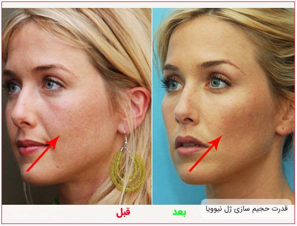تاثیر ژل نیوویا در فرم دهی گونه