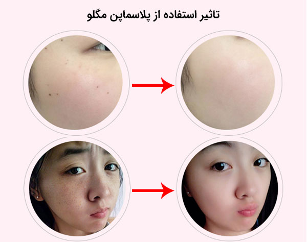 نحوه تاثیرگذاری پلاسماپن مگلو بر روی پوست به زیبایی به تصویر کشیده شده است.