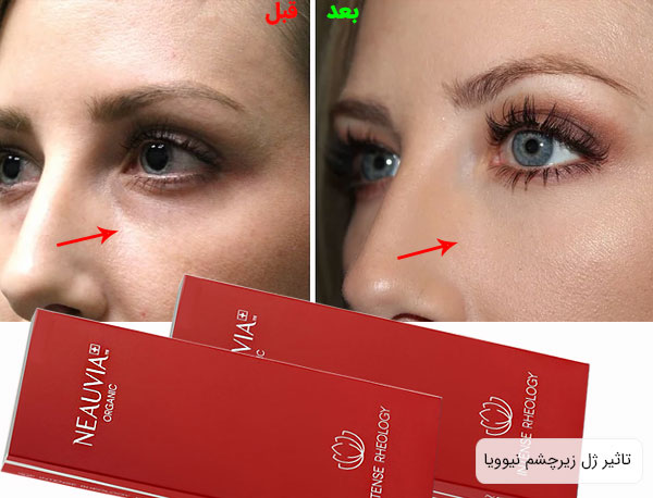 تصویری از تاثیر ژل زیرچشم نیوویا بر زیر چشم برای خرید فیلر زیر چشم نیوویا