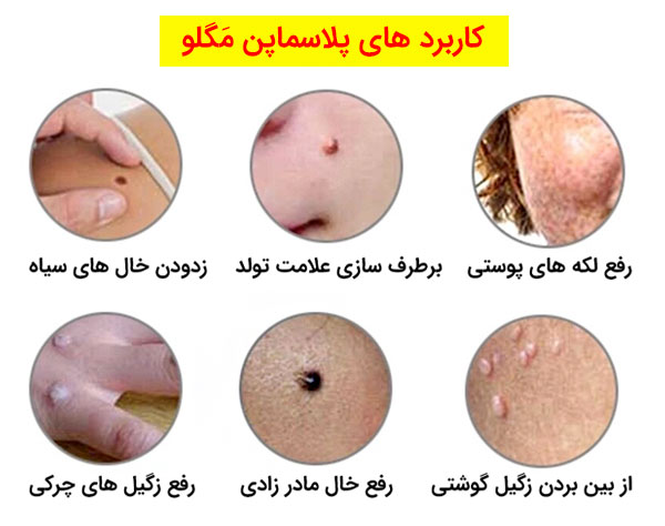 تصویر موارد استفاده از پلاسماپن مگلو در نواحی مختلف صورت و بدن در عکس کاملا مشهود می باشد.