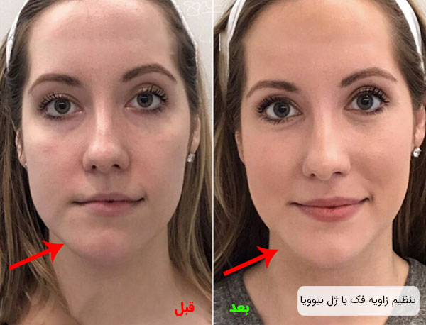 تنظیم زاویه فک و قیمت ژل گونه نیوویا استیمولیت