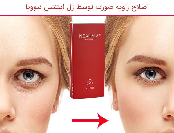 اصلاح زاویه صورت یک دختر خانم و قیمت ژل اینتنس نیوویا ایتالیا