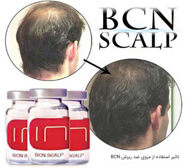 تصویری از موی سر قوی شده یک پسر در کنار ویال مزوی اسکالپ بی سی ان