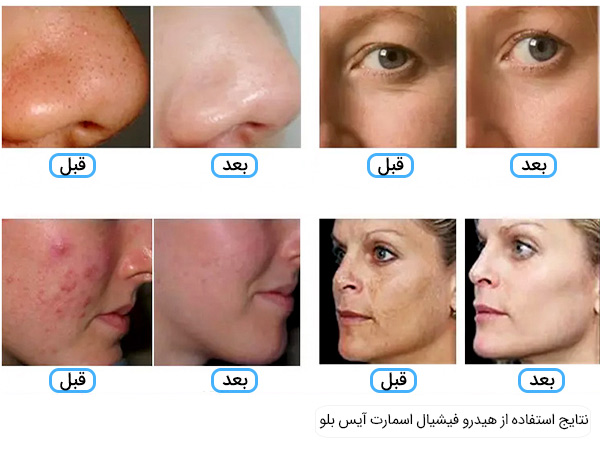 نتایج استفاده از دستگاه فیشیال و آنالیزور پوست اسمارت آیس بلو