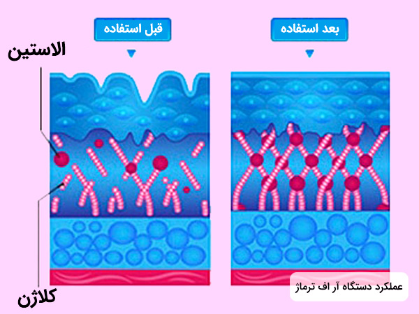 نحوه عملکرد دستگاه آر اف فرکشنال ترماژ در تحریک تولید کلاژن و الاستین پوست