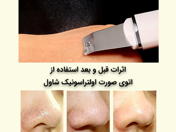 نحوه استفاده از دستگاه اتوي صورت درما اف التراسونيک و اثرات استفاده از دستگاه روی بینی