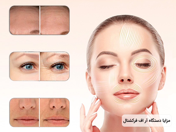 تصویر یک خانم جوان که پوست صاف و روشنی دارد و چشم های خود را بسته است . به همراه کاربرد دستگاه آر اف فرکشنال بر روی پیشانی و چشم و دهان