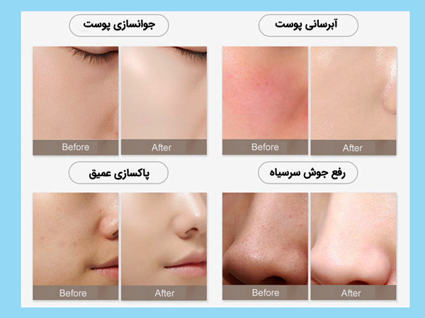 زیباسازی پوست صورت با دستگاه هيدروفيشيال 7 کاره موتور سنگين
