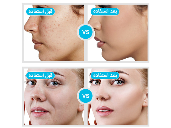 مقایسه نتایج قبل و بعد از جوانسازی صورت بوسیله دستگاه هیدروفیشیال 6 کاره به همراه تصویر صورت پیر و جوان دو خانم