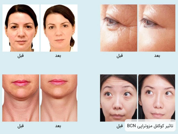 تصاویر قبل و یعد از استفاده از کوکتل های مزوتراپی بی سی ان با هدف خرید کوکتل مزوتراپی BCN