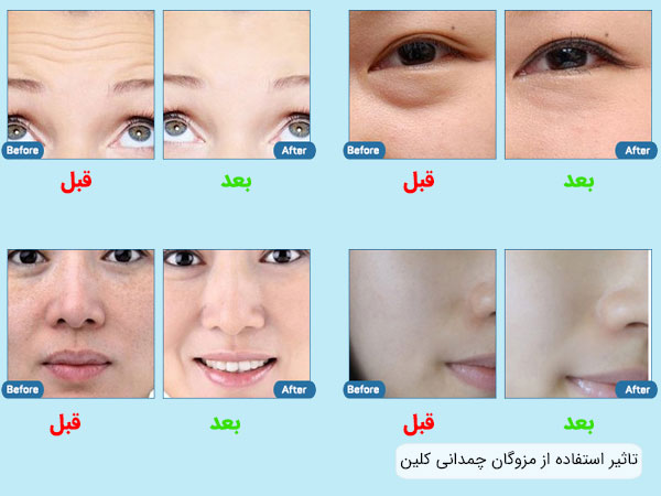 تاثیر استفاده از مزوگان کلینیکی کلین بر روی قسمت های مختلف صورت