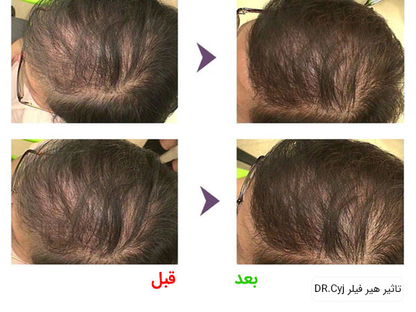 فیلر مو دکتر cyj تاثیر استفاده از فیلر دکتر سی وای جی