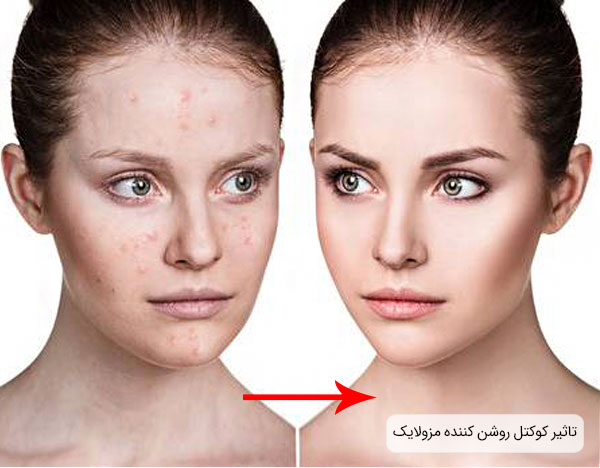 تاثیر استفاده از مزوی ضد لک و روشن کننده پوست صورت مزولایک اسپانیا با بهترین قیمت و کیفیت