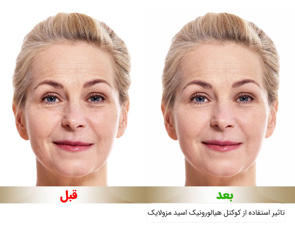 تاثیر استفاده از کوکتل هیالورونیک اسید مزولایک اسپانیا بر روی پوست صورت
