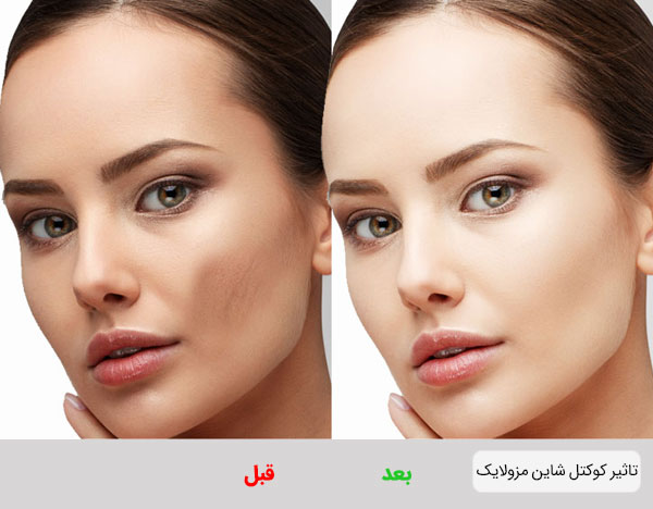 کوکتل سفید کننده شاین مزولایک و تاثیر آن بر صورت یک دختر خانم
