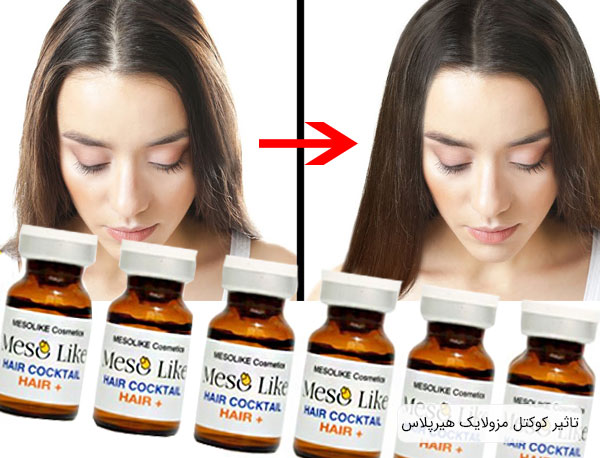 تاثیر استفاده از کوکتل هیرپلاس مزولایک بعد از چند روز
