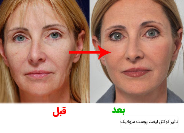 تصویری از قبل و بعد از استفاده از کوکتل لیفت مزولایک