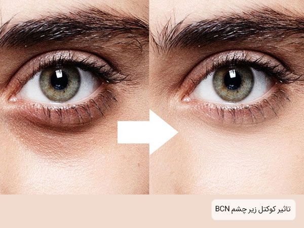 قبل و بعد از استفاده از کوکتل زیر چشم bcn به همراه قیمت کوکتل زیر چشم بی سی ان