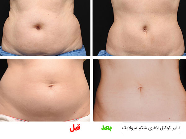 تاثیر استفاده از کوکتل لاغری شکم مزولایک اسپانیا در تصویر کاملا مشهود می باشد.