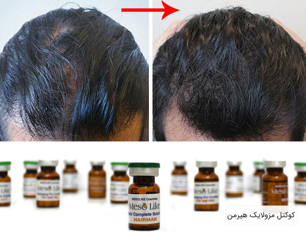 کوکتل مزوتراپی هیرمن مو مخصوص آقایان با بهترین و با کیفیت ، اصل اسپانیا