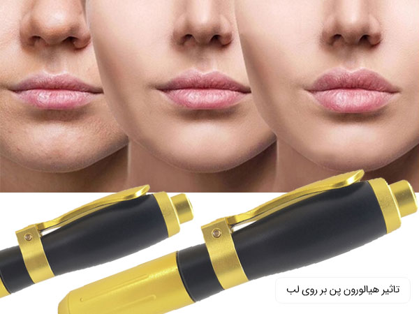 تاثیر استفاده از هیالورون پن بر روی لب ها