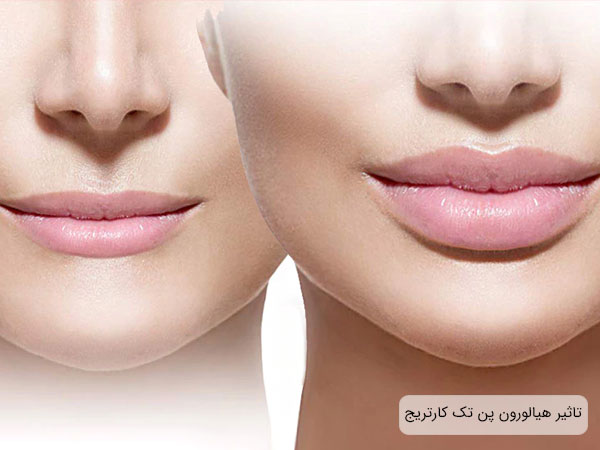 تاثیر هیالورون پن در تزریق هیالورونیک اسید