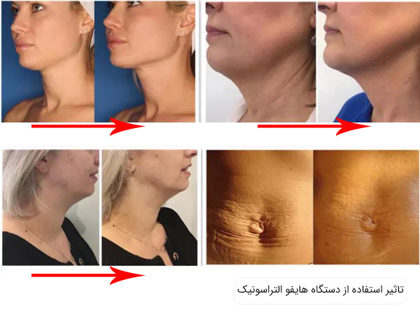تاثیر دستگاه هایفو الترا با بهترین کیفیت