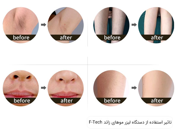 تاثیر استفاده از دستگاه لیزر موهای زائد نواحی مختلف بدن