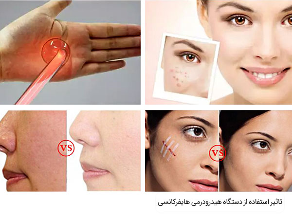 تاثیر استفاده از دستگاه هیدرودرمی های فرکانسی پرتابل