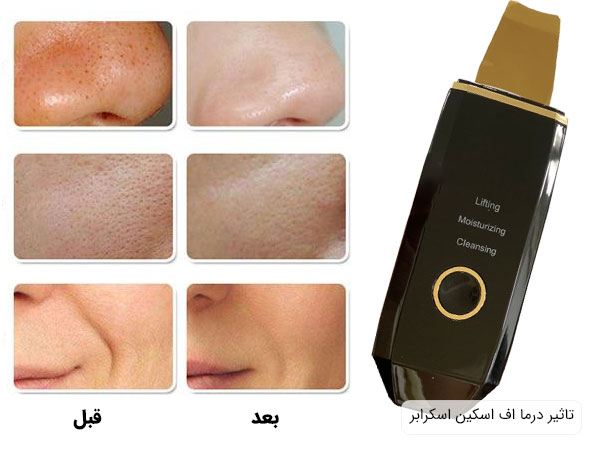 اتوی صورت اسکین اسکرابر استفاده از آن برای رفع ضایعات پوست